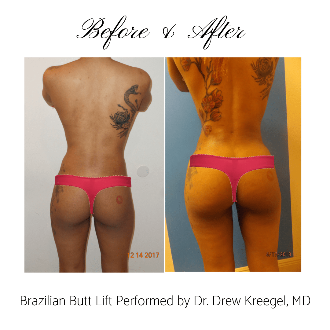 BBL - Before & After 2