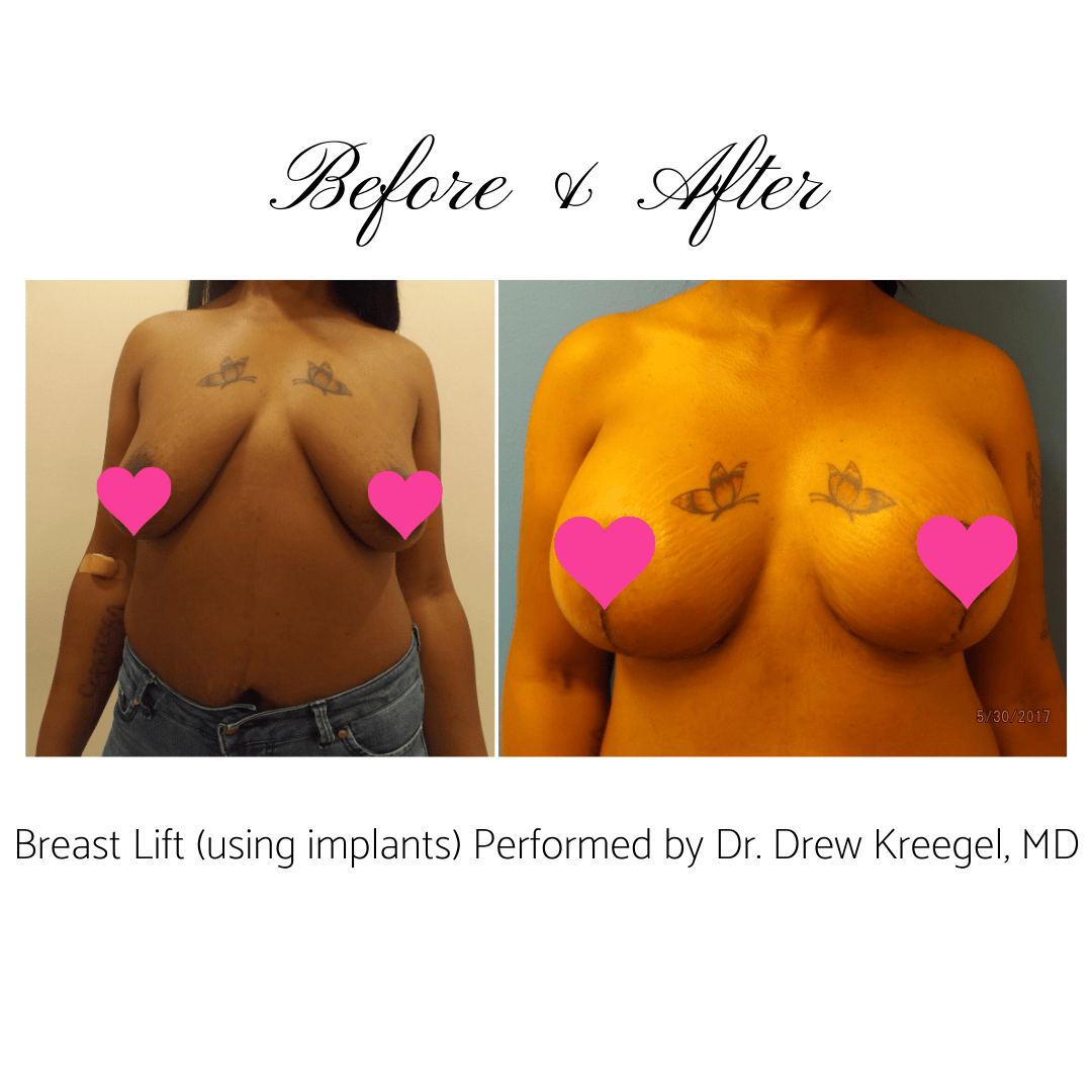 Breast Augmentation Before & After 5