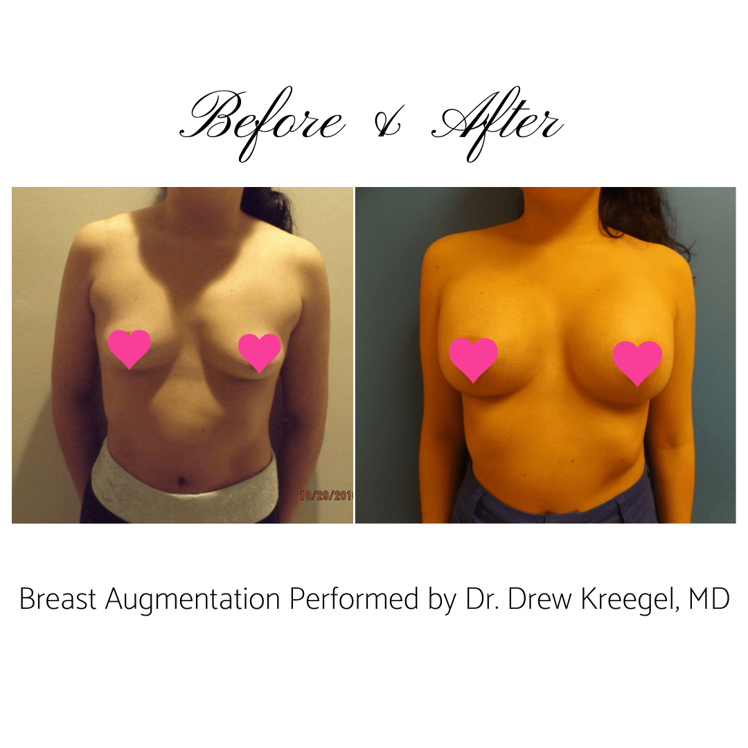 Breast Augmentation Before & After6